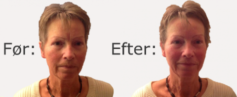 Japansk Lifting før og efter